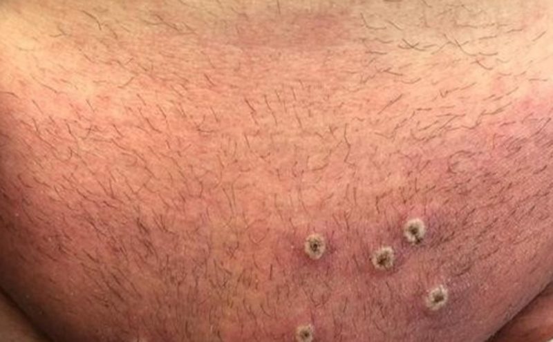 Seremi de Salud confirma primer caso de viruela del mono en la Región de O’Higgins